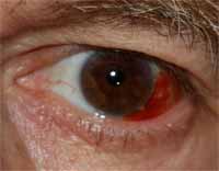 BD Eye
